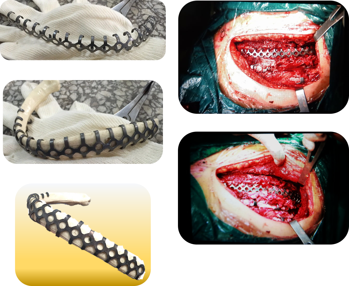 ribfixator